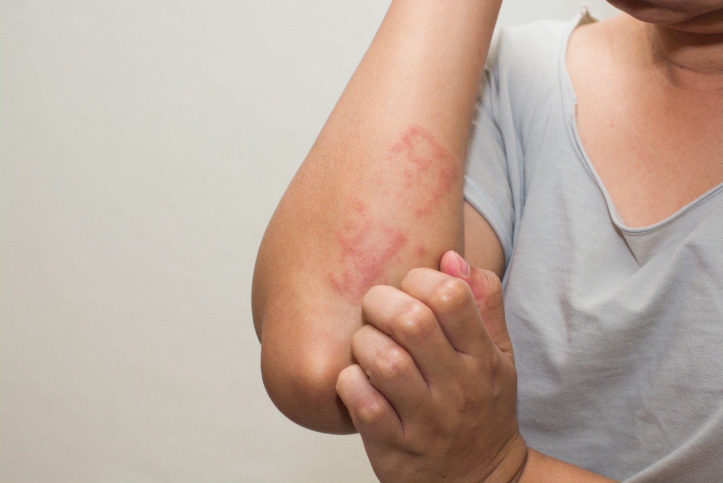 Allergy Screening